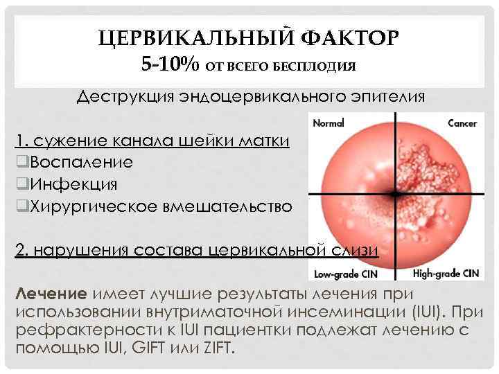 ЦЕРВИКАЛЬНЫЙ ФАКТОР 5 -10% ОТ ВСЕГО БЕСПЛОДИЯ Деструкция эндоцервикального эпителия 1. сужение канала шейки