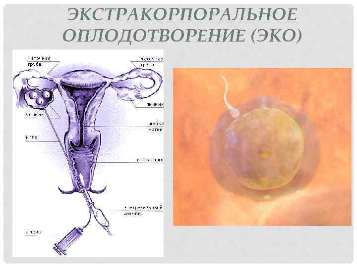 ЭКСТРАКОРПОРАЛЬНОЕ ОПЛОДОТВОРЕНИЕ (ЭКО) 