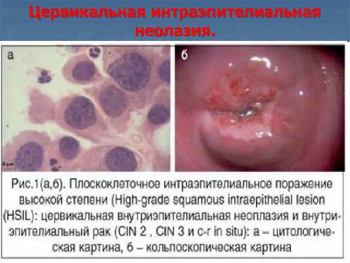 Цервикальная интраэпителиальная неолазия. 