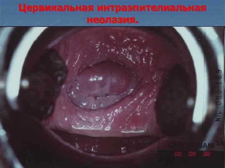 Цервикальная интраэпителиальная неолазия. 