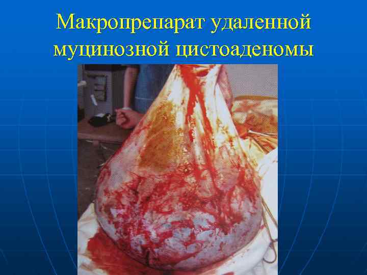 Макропрепарат удаленной муцинозной цистоаденомы 