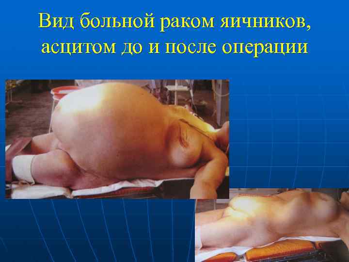 Вид больной раком яичников, асцитом до и после операции 