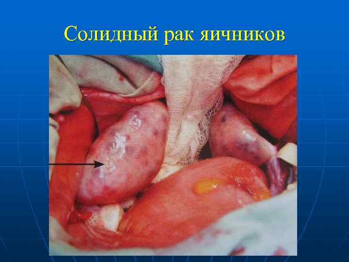 Солидный рак яичников 