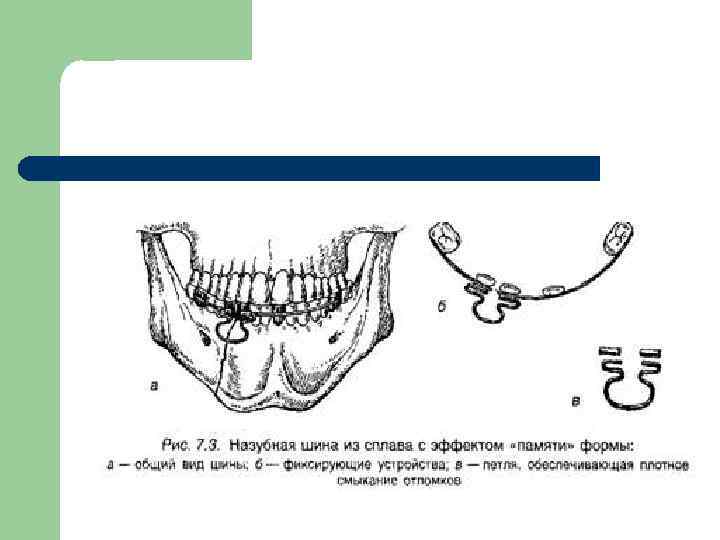 Методы временной и постоянной иммобилизации отломков челюстей презентация