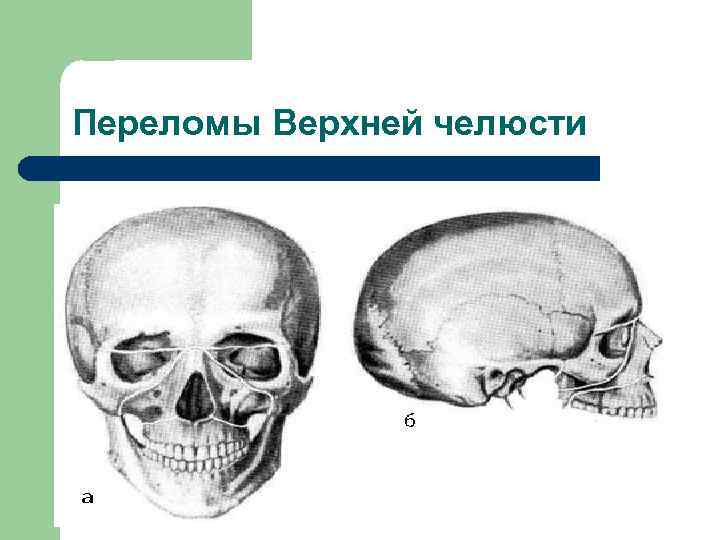 Переломы челюстей презентация