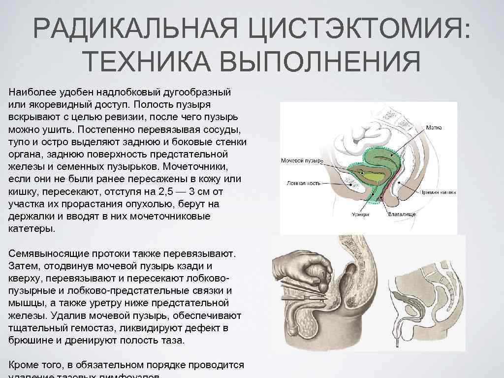 Удаления мочевого пузыря у мужчин отзывы