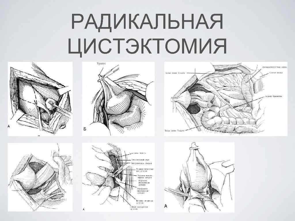 Цистэктомия. Цистэктомия мочевого пузыря. Радикальная цистэктомия мочевого пузыря. Цистэктомия мочевого пузыря ход операции. Техника операции цистэктомии.