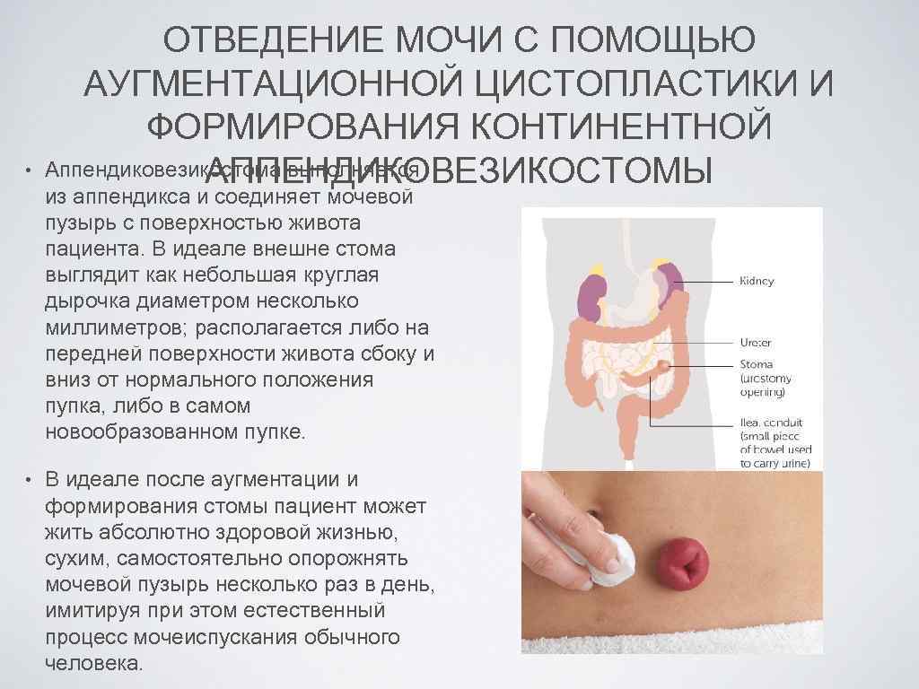  • ОТВЕДЕНИЕ МОЧИ С ПОМОЩЬЮ АУГМЕНТАЦИОННОЙ ЦИСТОПЛАСТИКИ И ФОРМИРОВАНИЯ КОНТИНЕНТНОЙ Аппендиковезикостома выполняется АППЕНДИКОВЕЗИКОСТОМЫ