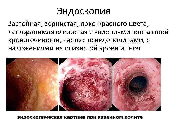 Эндоскопия Застойная, зернистая, ярко-красного цвета, легкоранимая слизистая с явлениями контактной кровоточивости, часто с псевдополипами,