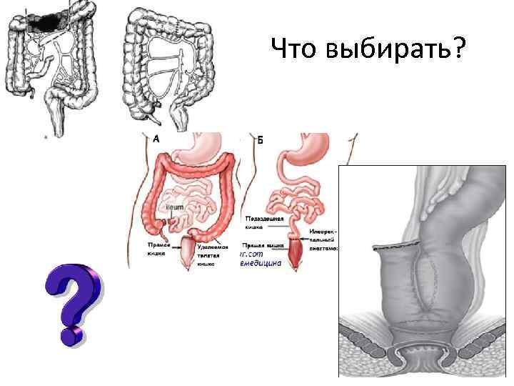 Что выбирать? 