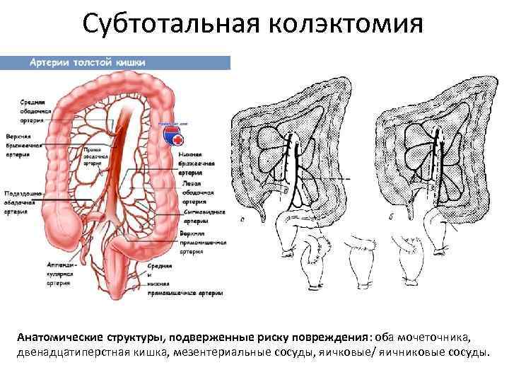 Субтотальная колэктомия Анатомические структуры, подверженные риску повреждения: оба мочеточника, двенадцатиперстная кишка, мезентериальные сосуды, яичковые/