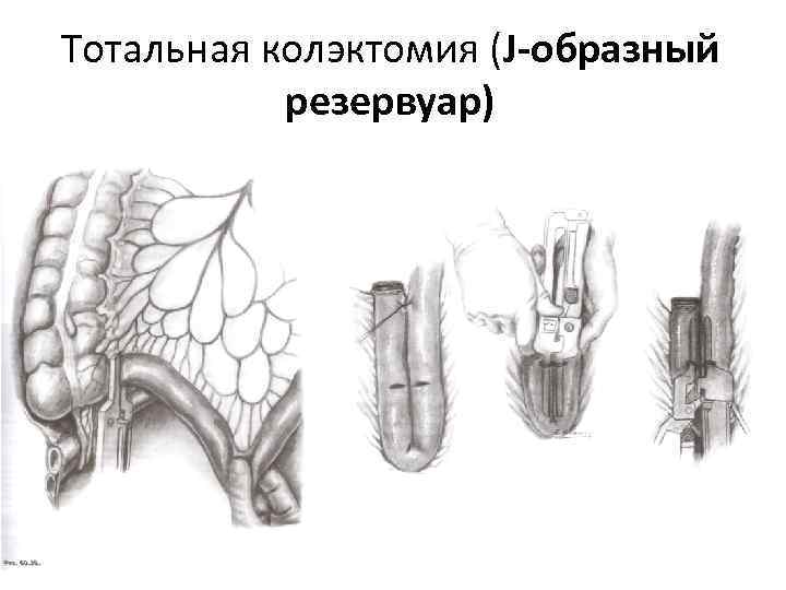 Тотальная колэктомия (J-образный резервуар) 