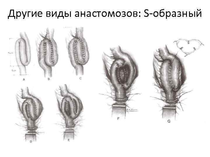 Другие виды анастомозов: S-образный 