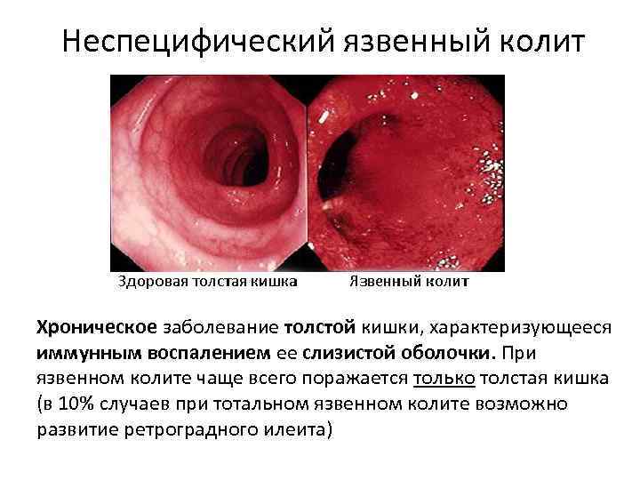 Неспецифический язвенный колит Хроническое заболевание толстой кишки, характеризующееся иммунным воспалением ее слизистой оболочки. При