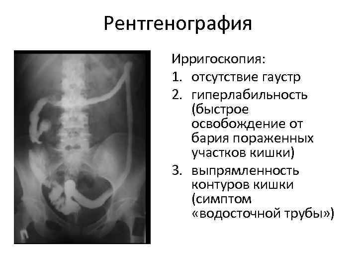 Рентгенография Ирригоскопия: 1. отсутствие гаустр 2. гиперлабильность (быстрое освобождение от бария пораженных участков кишки)