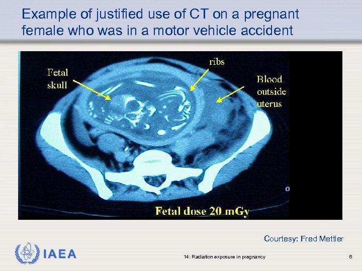 Example of justified use of CT on a pregnant female who was in a