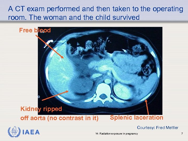 A CT exam performed and then taken to the operating room. The woman and