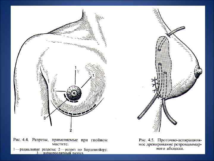 Схема хирургических разрезов при маститах