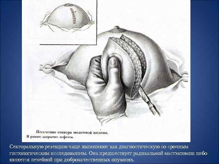 Секторальную резекцию чаще выполняют как диагностическую со срочным гистологическим исследованием. Она предшествует радикальной мастэктомии