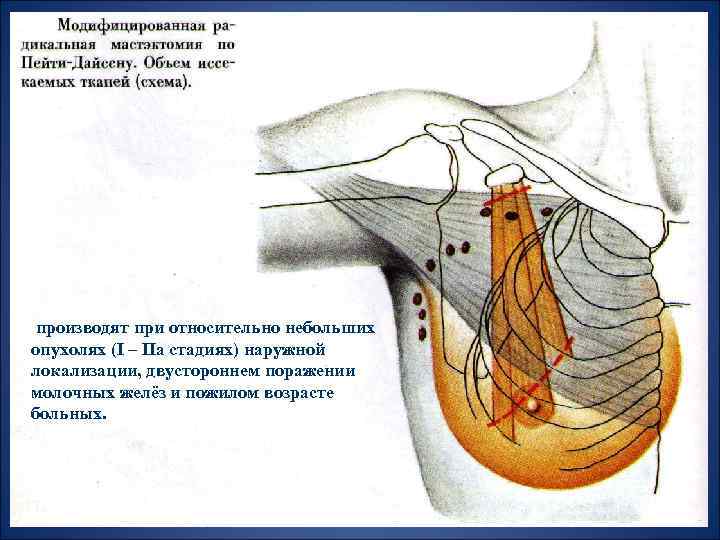 производят при относительно небольших опухолях (I – IIa стадиях) наружной локализации, двустороннем поражении молочных