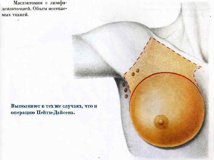 Выполняют в тех же случаях, что и операцию Пейти-Дайсена. 