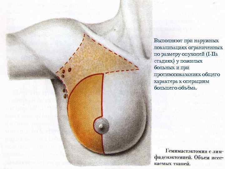 Выполняют при наружных локализациях ограниченных по размеру опухолей (I-IIa стадиях) у пожилых больных и