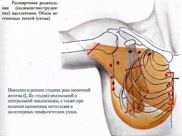 Показана в ранних стадиях рака молочной железы (I, IIa стадия) медиальной и центральной локализации,