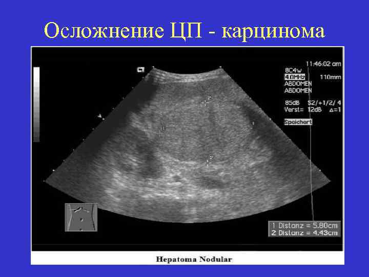 Осложнение ЦП карцинома 