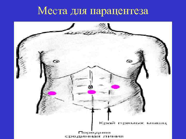 Места для парацентеза 