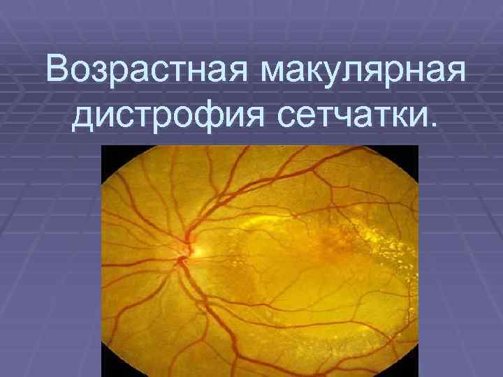 Возрастная макулярная дистрофия сетчатки. 