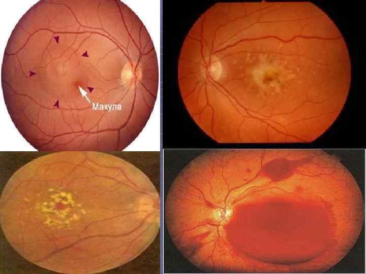 1 -Друзы. 2 -Отслойка пигментного эпителия 3 -субретинальные эксудаты 
