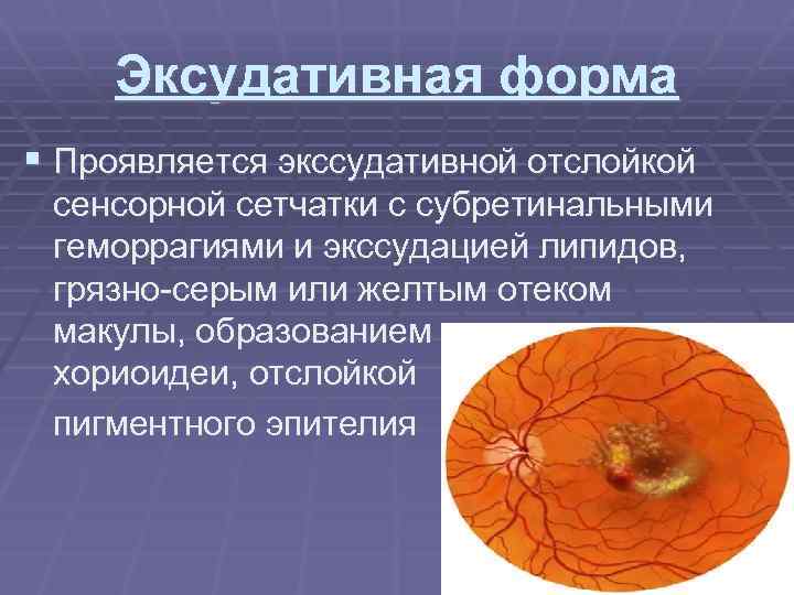 Эксудативная форма § Проявляется экссудативной отслойкой сенсорной сетчатки с субретинальными геморрагиями и экссудацией липидов,
