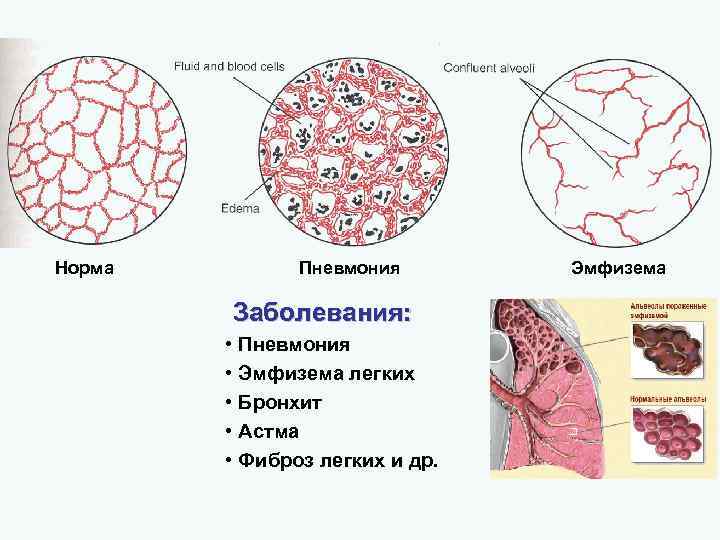 Норма Пневмония Заболевания: • Пневмония • Эмфизема легких • Бронхит • Астма • Фиброз