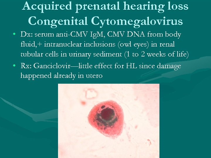 Acquired prenatal hearing loss Congenital Cytomegalovirus • Dx: serum anti-CMV Ig. M, CMV DNA