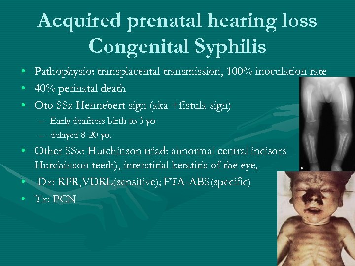 Acquired prenatal hearing loss Congenital Syphilis • • • Pathophysio: transplacental transmission, 100% inoculation