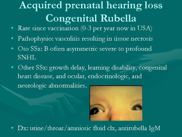  • • • Acquired prenatal hearing loss Congenital Rubella Rare since vaccination (0