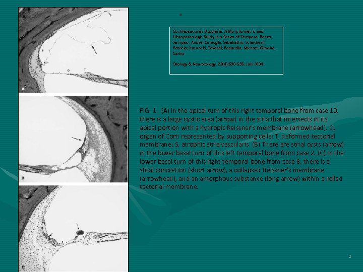 . Cochleosaccular Dysplasia: A Morphometric and Histopathologic Study in a Series of Temporal Bones.
