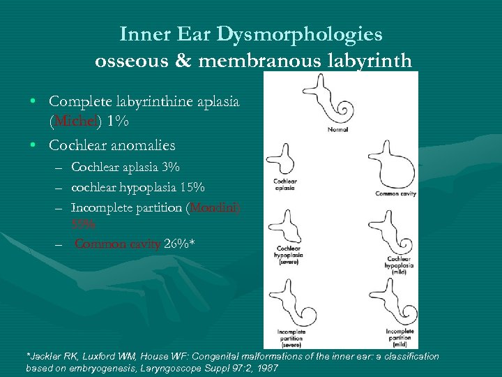 Inner Ear Dysmorphologies osseous & membranous labyrinth • Complete labyrinthine aplasia (Michel) 1% •