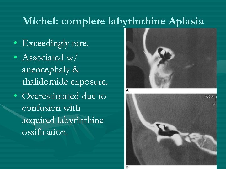 Michel: complete labyrinthine Aplasia • Exceedingly rare. • Associated w/ anencephaly & thalidomide exposure.