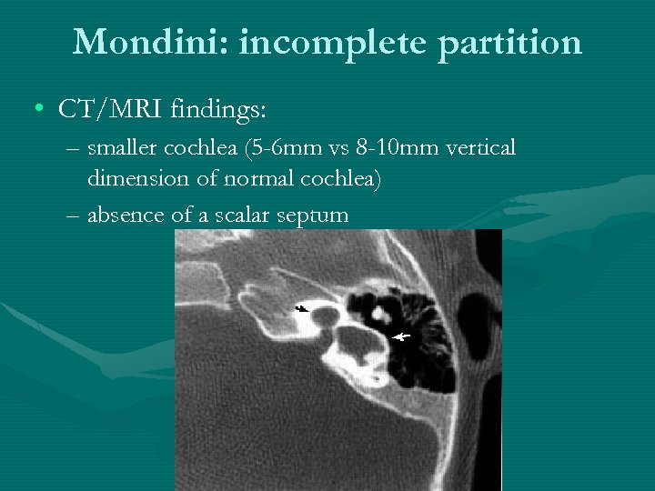 Mondini: incomplete partition • CT/MRI findings: – smaller cochlea (5 -6 mm vs 8