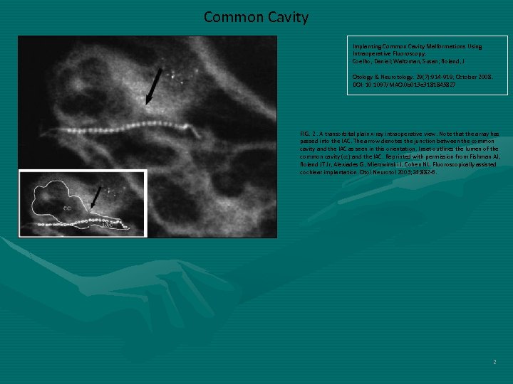 Common Cavity Implanting Common Cavity Malformations Using Intraoperative Fluoroscopy. Coelho, Daniel; Waltzman, Susan; Roland,