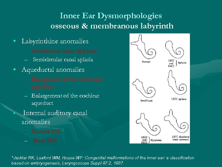 Inner Ear Dysmorphologies osseous & membranous labyrinth • Labyrinthine anomalies – Semicircular canal dysplasia