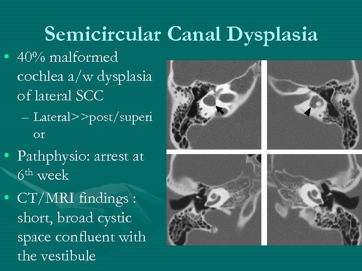 Semicircular Canal Dysplasia • 40% malformed cochlea a/w dysplasia of lateral SCC – Lateral>>post/superi