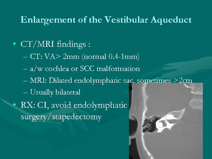 Enlargement of the Vestibular Aqueduct • CT/MRI findings : – CT: VA> 2 mm