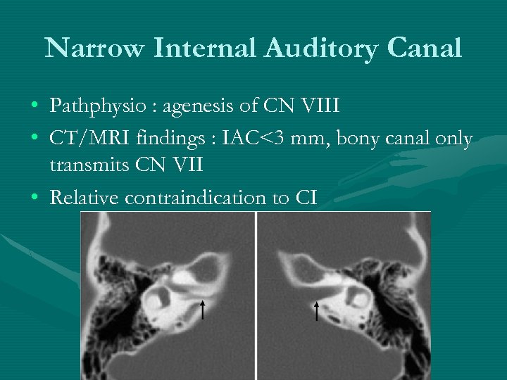 Narrow Internal Auditory Canal • Pathphysio : agenesis of CN VIII • CT/MRI findings