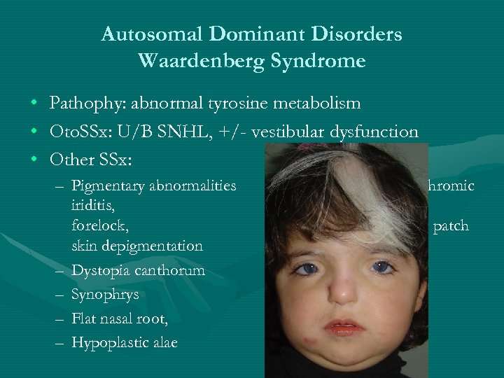 Autosomal Dominant Disorders Waardenberg Syndrome • • • Pathophy: abnormal tyrosine metabolism Oto. SSx: