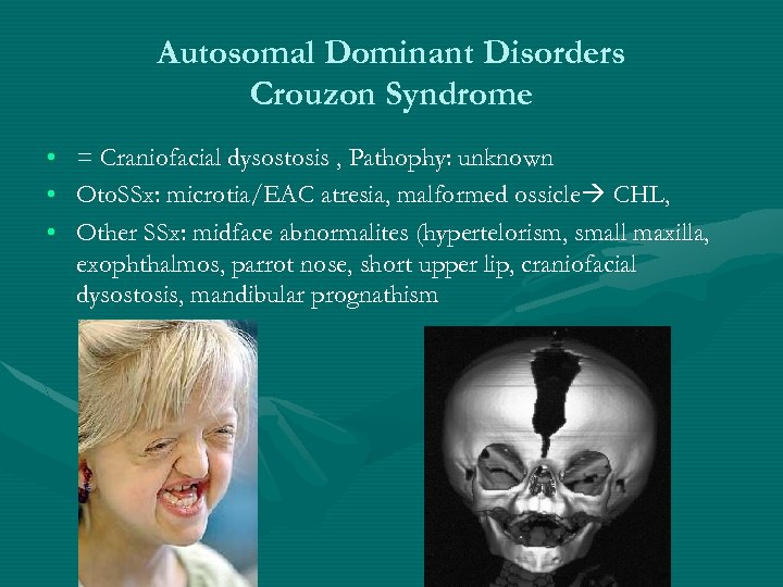 Autosomal Dominant Disorders Crouzon Syndrome • • • = Craniofacial dysostosis , Pathophy: unknown