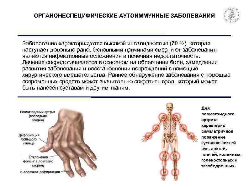 ОРГАНОНЕСПЕЦИФИЧЕСКИЕ АУТОИММУННЫЕ ЗАБОЛЕВАНИЯ Заболевание характеризуется высокой инвалидностью (70 %), которая наступает довольно рано. Основными