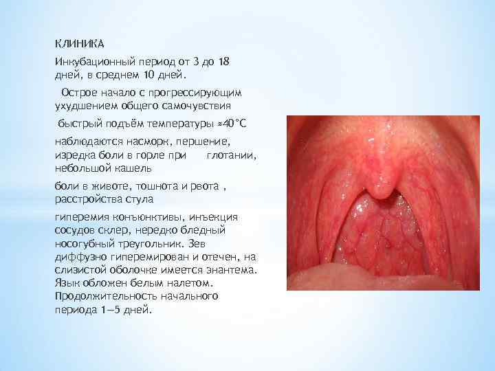 КЛИНИКА Инкубационный период от 3 до 18 дней, в среднем 10 дней. Острое начало