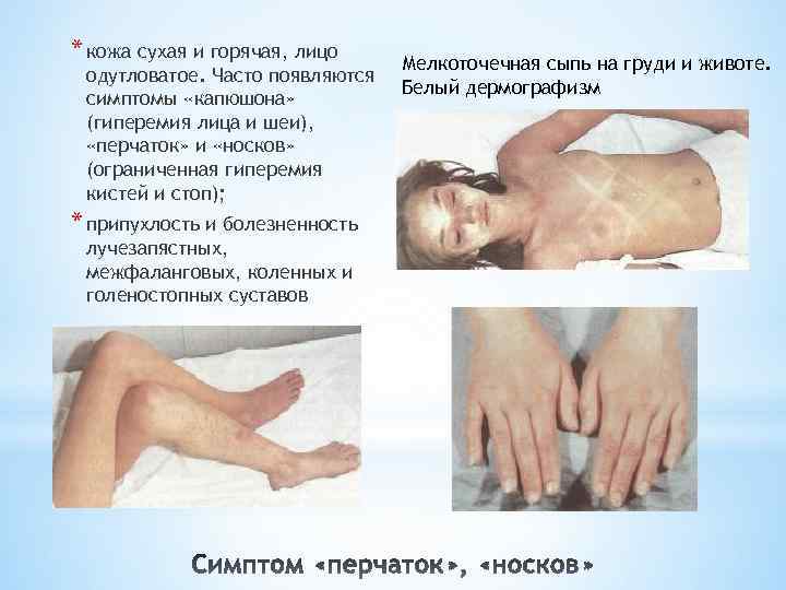 * кожа сухая и горячая, лицо одутловатое. Часто появляются симптомы «капюшона» (гиперемия лица и